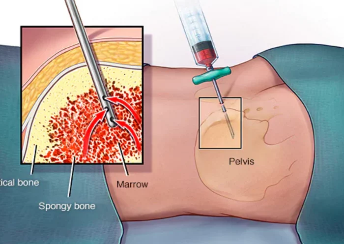 Now you will not have to bear the pain of bone marrow biopsy, the machine will tell whether there is blood cancer or not!