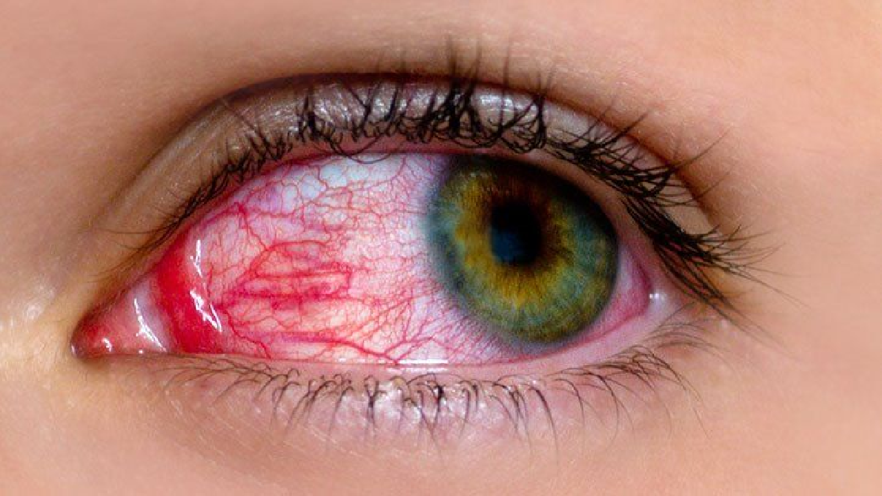 pink eye infection | Sach Bedhadak